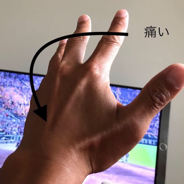 尺側手根伸筋腱鞘炎 ばくち帳面 尺側手根伸筋腱鞘炎 ばくち帳面
