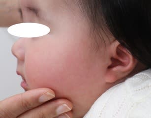 扁平母斑 生後2か月 女児 ドクターリコの明日もｈａｐｐｙ