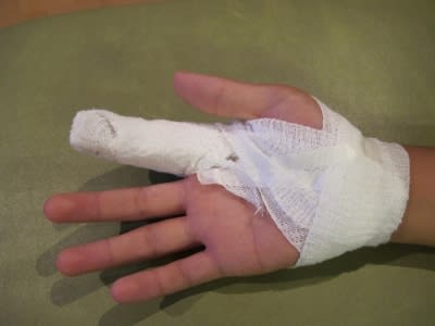 右指軟骨骨折 - Report of Yuki