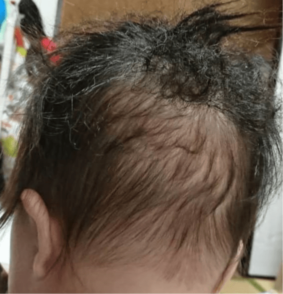 赤ちゃん 後頭部 毛 チリチリ englshfai