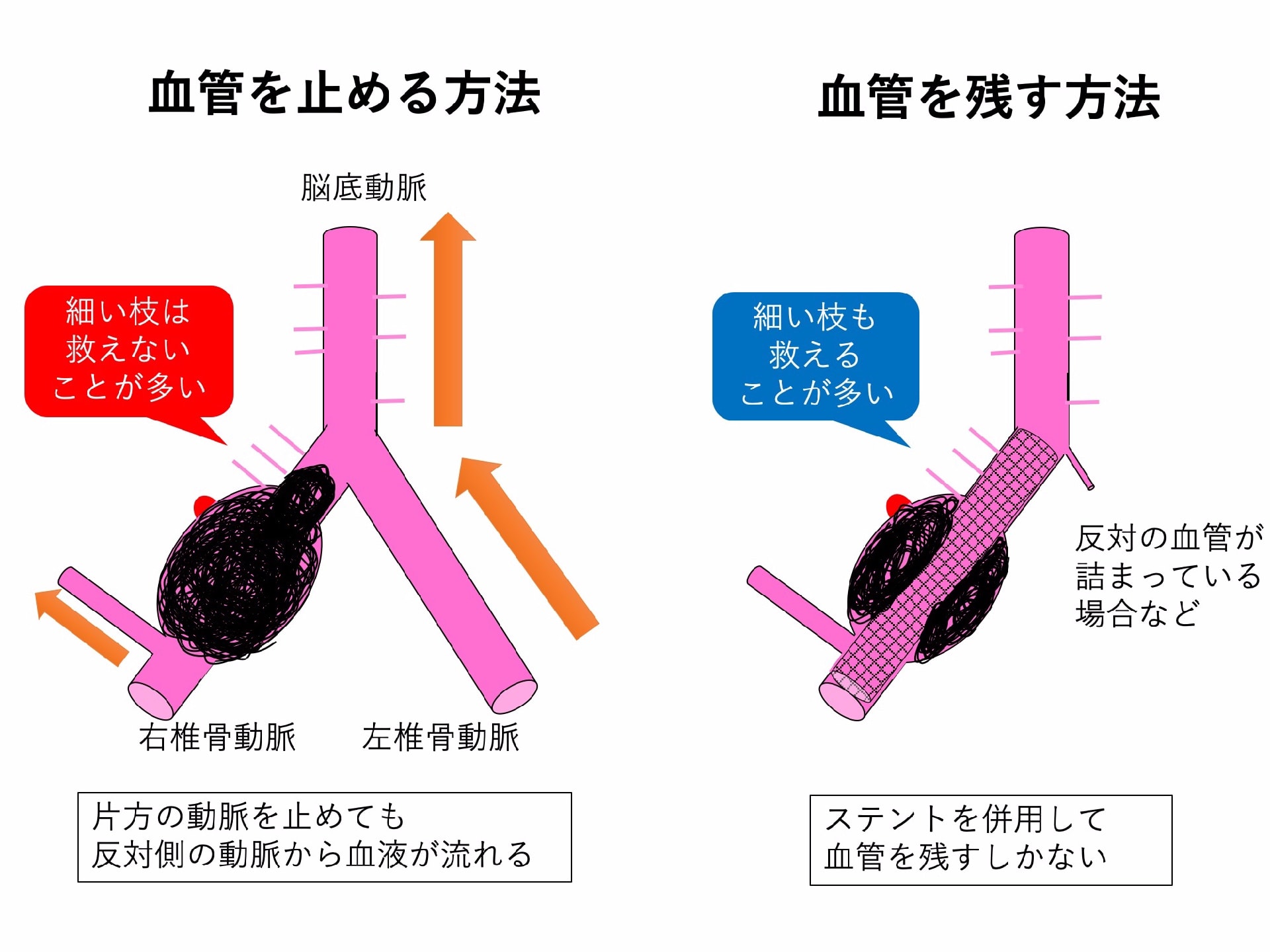 脳動脈瘤 その7 脳動脈瘤の種類 成因による分類 解離性動脈瘤 つづき2 脳卒中をやっつけろ