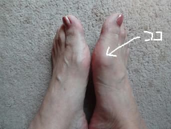 腫れ 足の指の付け根 足の親指の付け根が痛い!腫れ・違和感を感じる原因と対策は