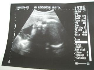 エコー写真 妊娠35週5日目 9ヶ月目 ナオの出産 子育て日記