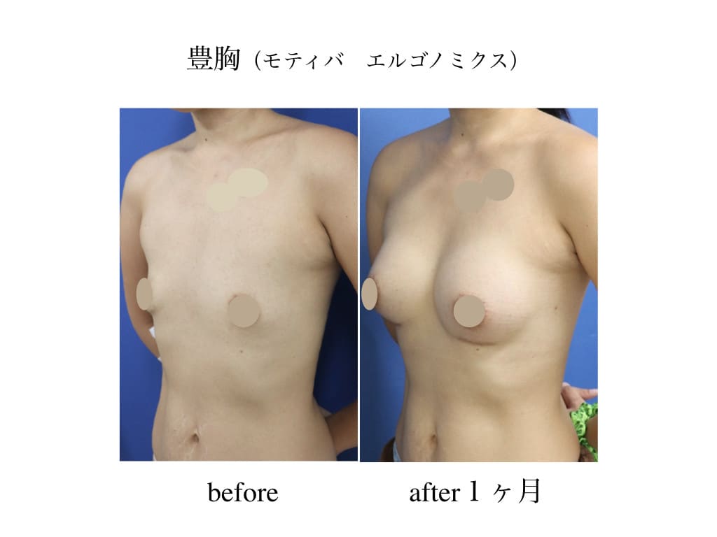 豊胸 モティバ エルゴノミクス 1ヶ月後 厚木で美しく