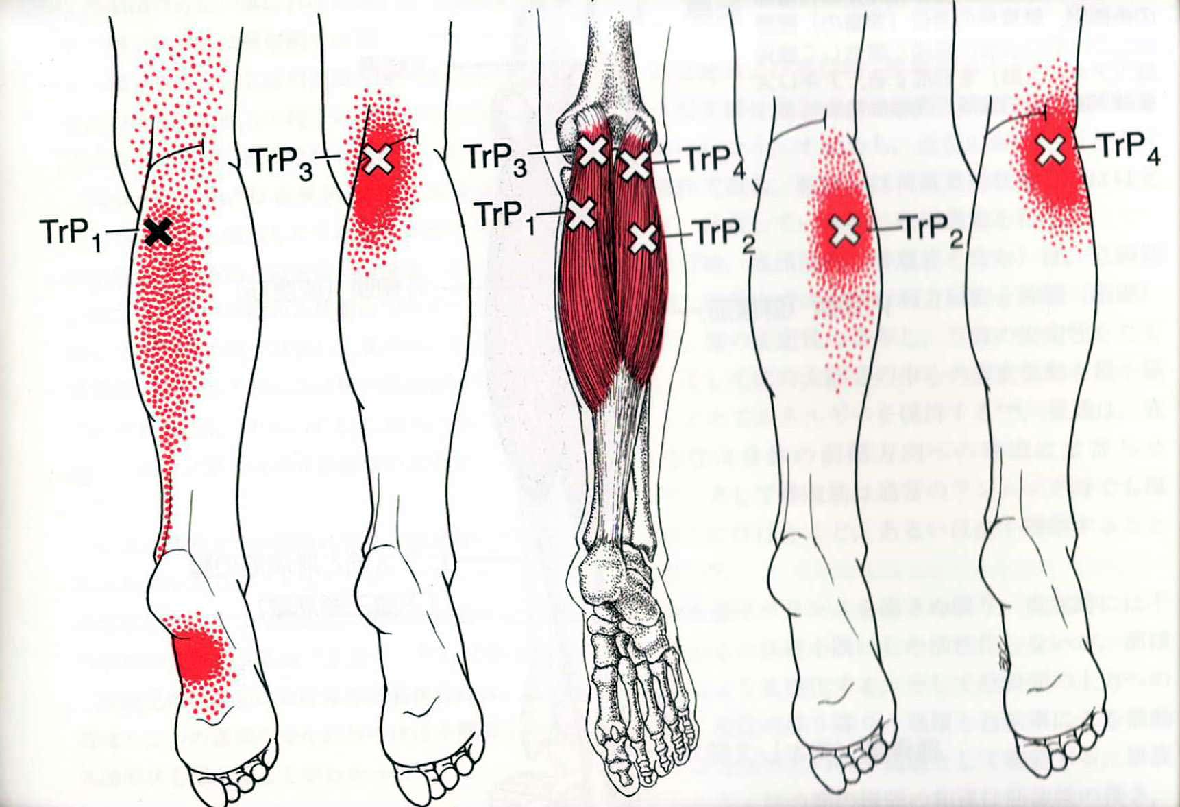 Ноющая боль в ногах ниже. Триггерные точки икроножной мышцы. Триггерные точки мышц голени. Триггерные точки колена. Массаж триггерных точек голени.