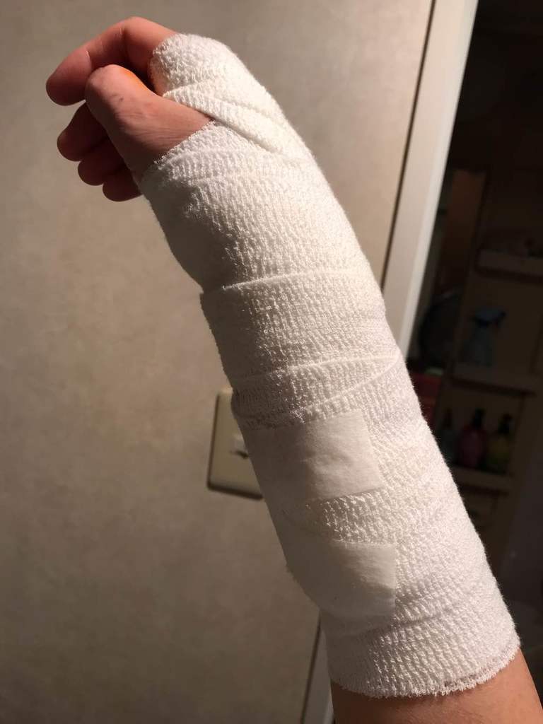 復帰 仕事 手首 骨折