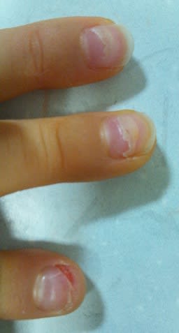 手足口病の後遺症 のようなもの りょーこのマネージャーな日々