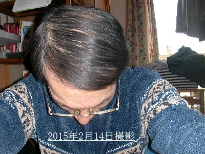 憧れのバーコードヘアースタイル カークランド製発毛剤ミノキシジル５ は髪の毛が生えてくる発毛剤です