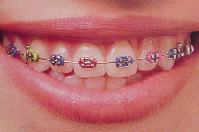 歯列矯正もおしゃれのひとつ 歯科カウンセラーの日記