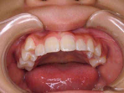 舌端裏後部歯茎音