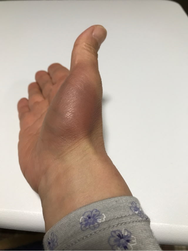 親指 の 付け根 腫れ
