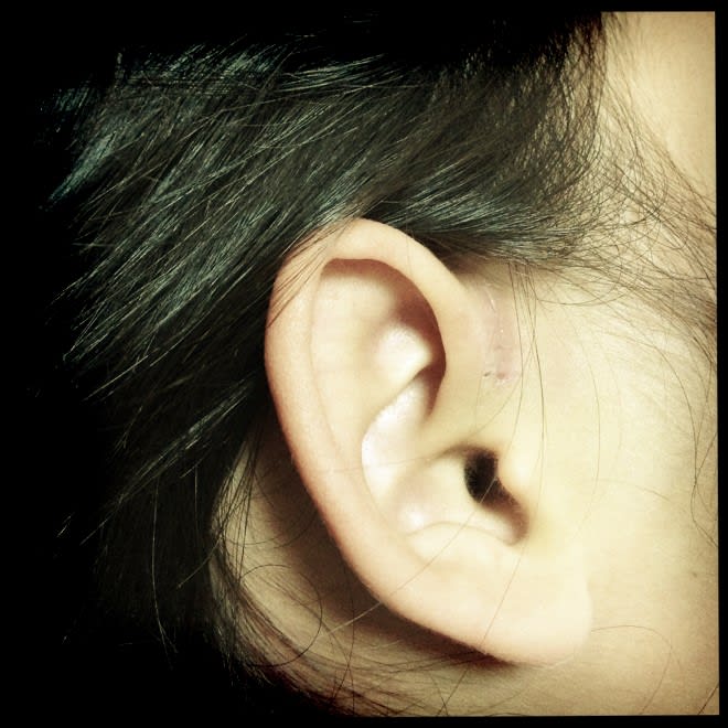 先天性耳瘻孔の手術から10日経過。半年もすると、手術後が全く分からなくなるそうです♪