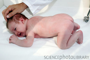 原始反射 新生児反射 ある産婦人科医のひとりごと