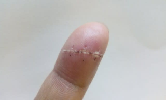 モリコロ 剪定ばさみによる手の怪我 カルス