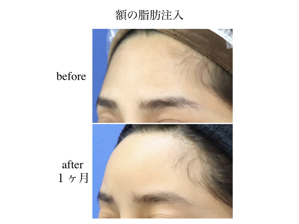 丸い額に 脂肪注入 1ヶ月後 厚木で美しく 丸い額に 脂肪注入 1ヶ月後 厚木で美しく