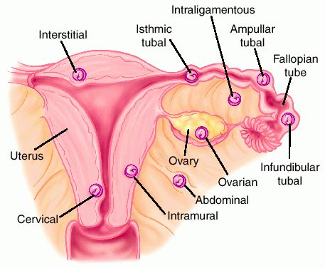 子宮外妊娠 症状