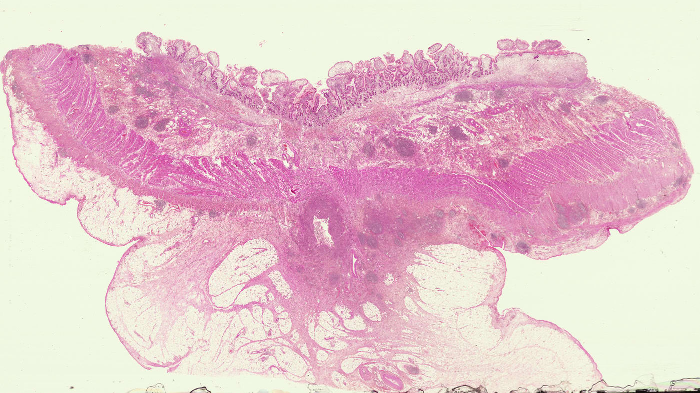 Crohn\'s rosary クローンのロザリオ 胃生検の小部屋 Cottage for Gastric Biopsy