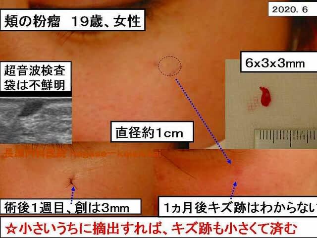 粉瘤 1 医療法人恵生会 長瀬内科医院 粉瘤 1 医療法人恵生会 長瀬内科医院