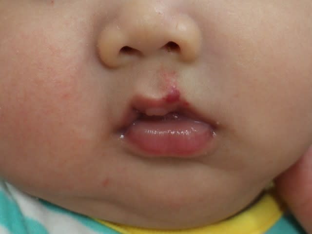 唇のいちご状血管腫 生後3か月 男の子 ドクターリコの明日もｈａｐｐｙ