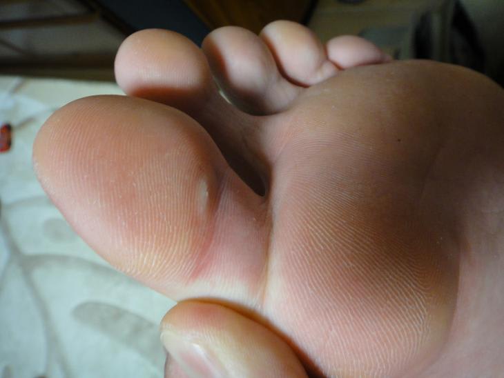 足 の 親指 皮 剥け