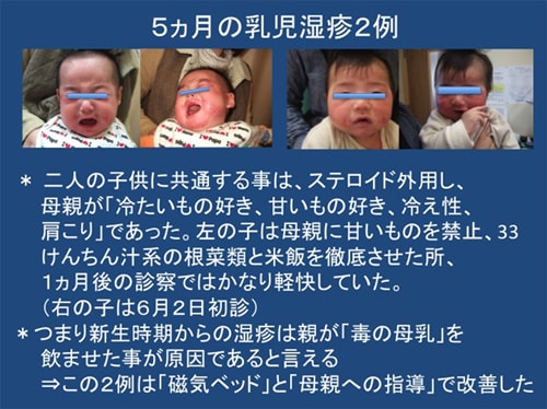 アトピー性皮膚炎 楢葉の症例 5ヵ月の乳児湿疹2例 永野医院