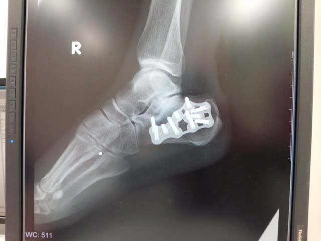 右踵骨折 治療が終了しました ブナの中庭で
