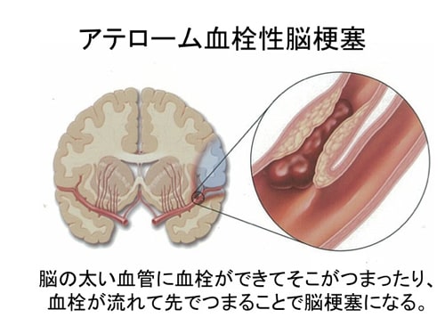 梗塞 脳 アテローム 性 血栓