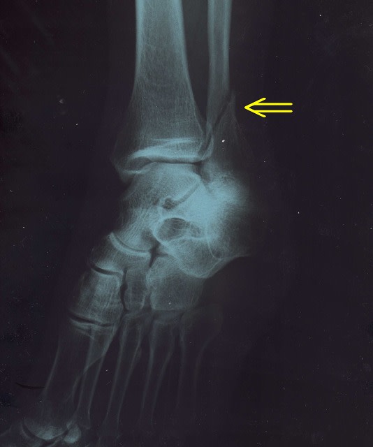 足の骨折は腓骨骨折 退院 健康自由メモ 高齢者の健康メモ