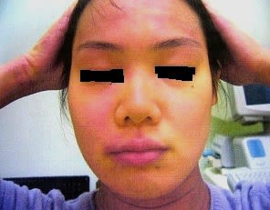 皮膚のトラブルは女性につきもの 続報２ １０年間のアトピー性皮膚炎 色素沈着症 通年性のアレルギー Gooブログはじめました