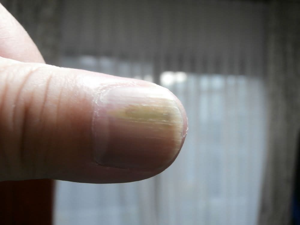 左手親指の爪の病気 - ＫＯｆｙの「倍行く」人生
