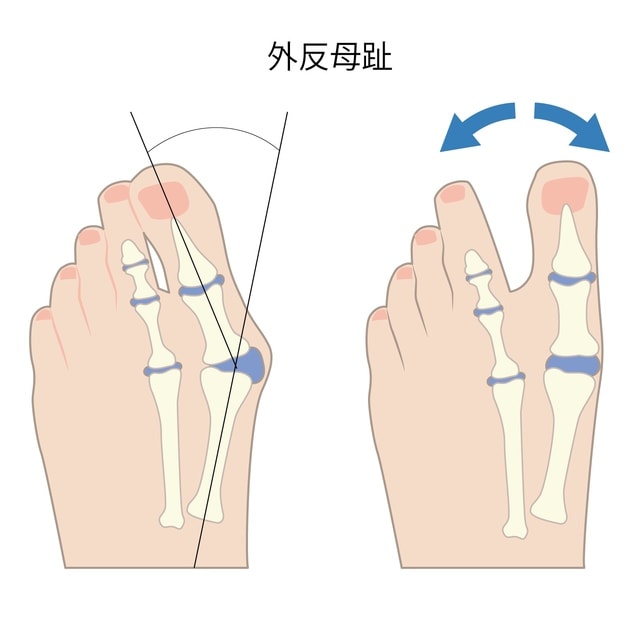 足のトラブル 外反母趾 ｏｄａｗａｒａケアセンター 健康ブログ