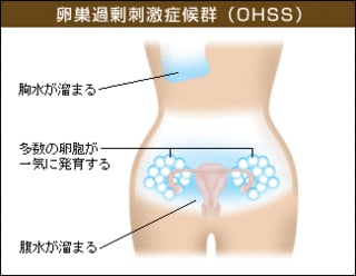 卵巣過剰刺激症候群 Ohss について 扇町レディースクリニック ブログページ