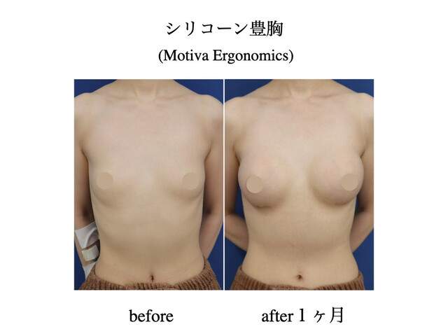 モティバ エルゴノミクス豊胸 1ヶ月後 厚木で美しく
