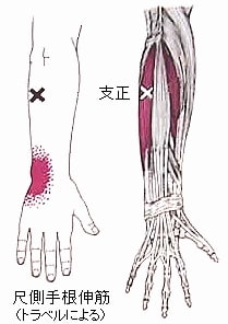 腕骨 陽谷 養老の位置と局所的意義 Ver 1 1 現代医学的鍼灸治療 腕骨 陽谷 養老の位置と局所的意義 Ver 1 1 現代医学的鍼灸治療