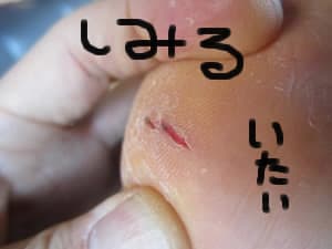 踵が割れた ４８歳の中年オヤジ 柔道を始める