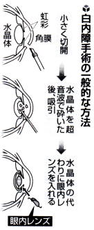 白内障手術の一般的な方法の図