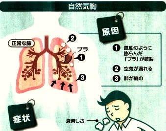 自然気胸の原因