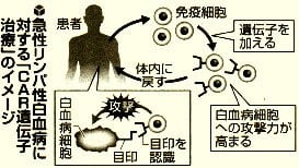 急性リンパ性白血病に対する「ＣＡＲ遺伝子治療」のイメージ図