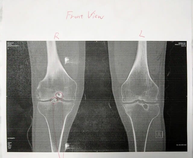 左脚の 高位脛骨骨切り術 と右膝の内視鏡関節鼠摘出手術 シラチャ日記