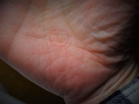 手のひらのブツブツ 落書き帳 手のひらのブツブツ 落書き帳