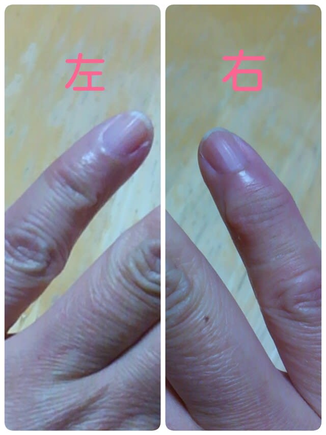 へバーデン結節 のほほん雑記帳 へバーデン結節 のほほん雑記帳