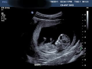 妊娠１２週０日の超音波検査 ベドリントンテリア レックスの成長日記と私の初妊娠ライフin Perth