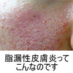 脂漏性皮膚炎の治し方 脂漏性皮膚炎の治し方
