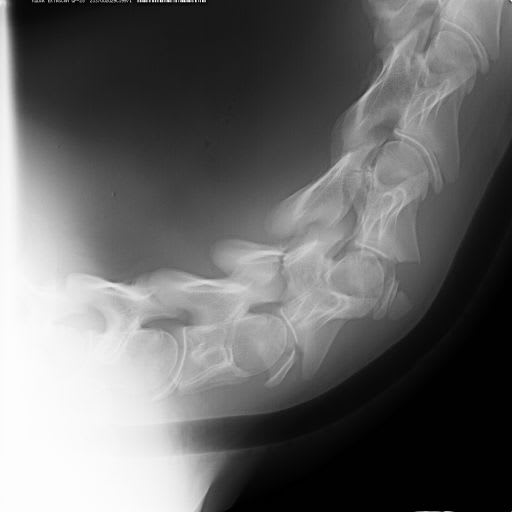 脱臼 頚椎 関節 ダウン症児の首の不安定性（環軸椎亜脱臼）