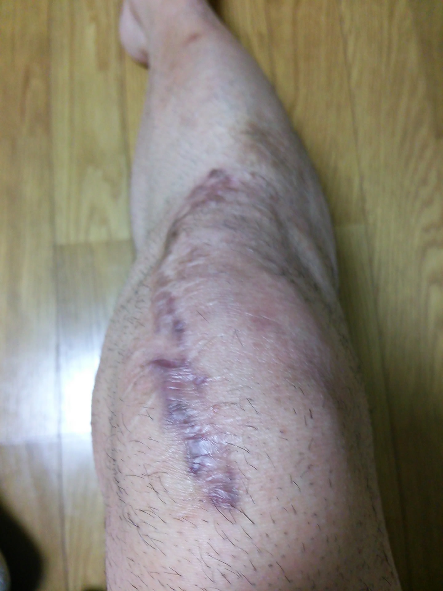 右膝膝蓋骨粉砕骨折から2年目 アップデート この1年でどれ位リハビリが進行したか シモキタのtokyoboy