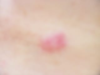 虫刺され？